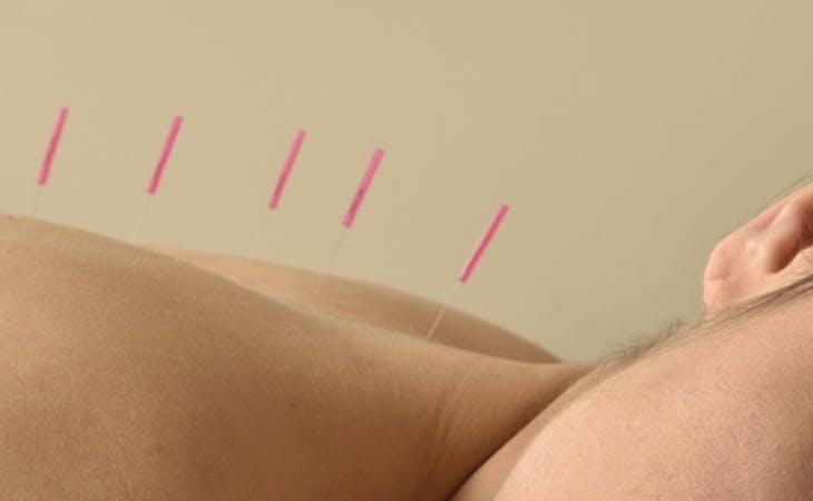 person getting acupuncture in back